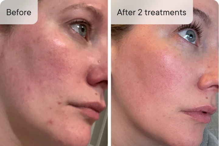 Hannah M. before and after Ouraskin treatment