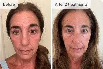 Linda P. before and after Ouraskin treatment