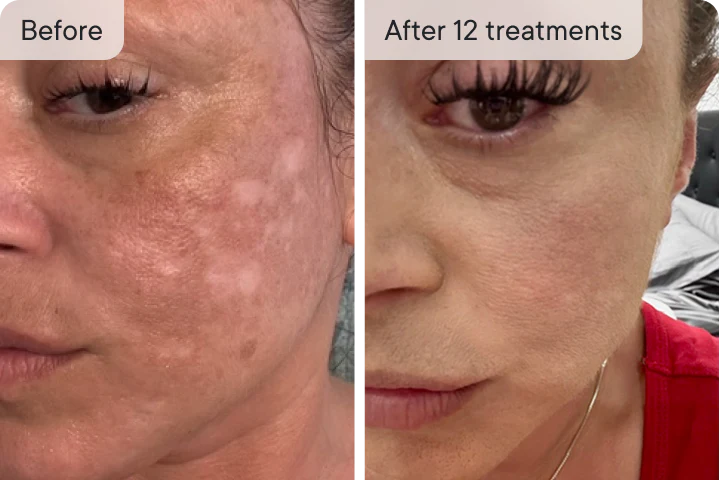 Rachel D. before and after Ouraskin treatment