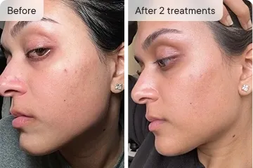 Priya S. before and after Ouraskin treatment