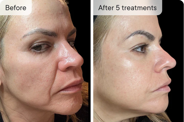 Elena V. before and after Ouraskin treatment