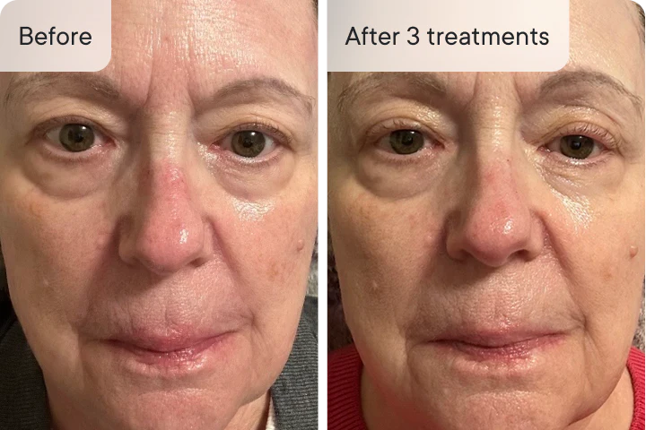 Margaret H. before and after Ouraskin treatment