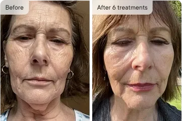 Diane K. before and after Ouraskin treatment