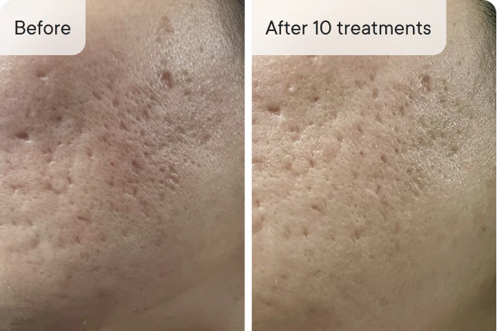 Sofia L. before and after Ouraskin treatment